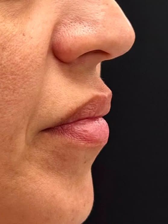 Preenchimento labial — hidratação e contorno — antes