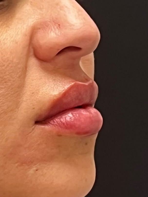 Preenchimento labial — hidratação e contorno — depois