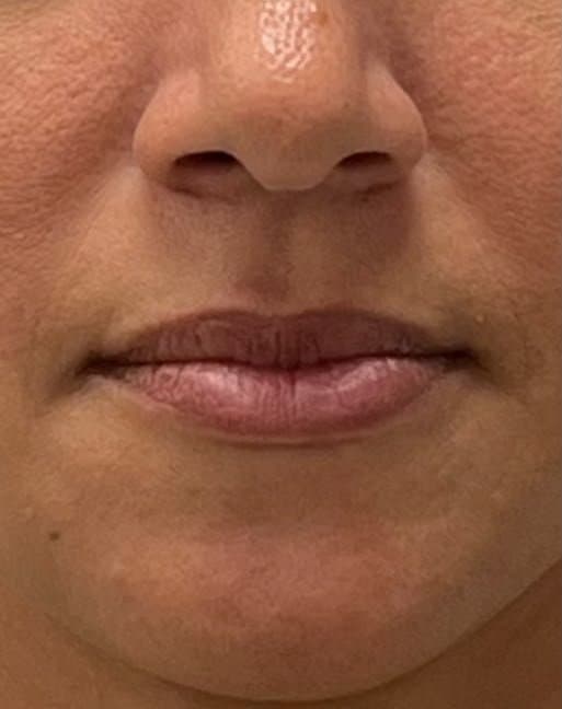 Preenchimento labial e bigode chinês — antes