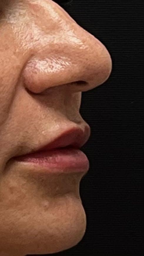 Preenchimento labial — contorno e hidratação — antes