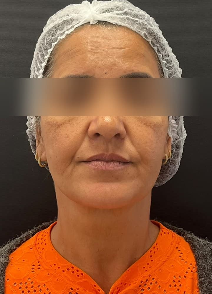 Preenchimento malar com efeito lifting — antes