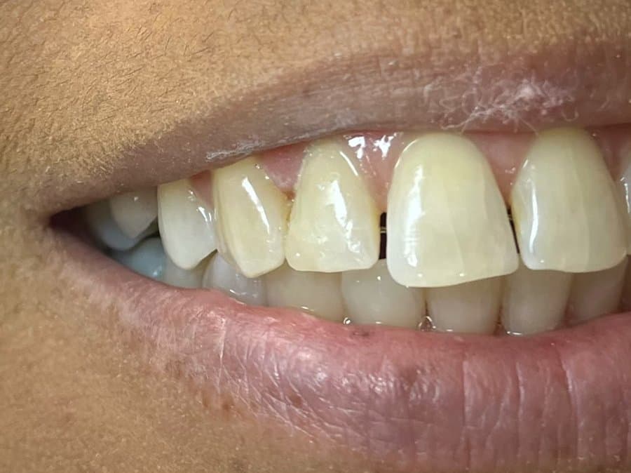 Restauração de ângulo incisal — depois